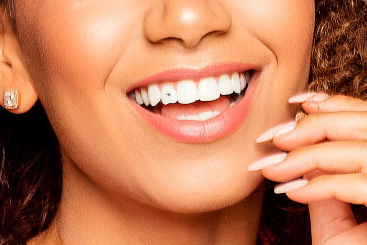 Imagem de uma mulher sorrindo, com piercing dental, simbolizando os cuidados com o adorno