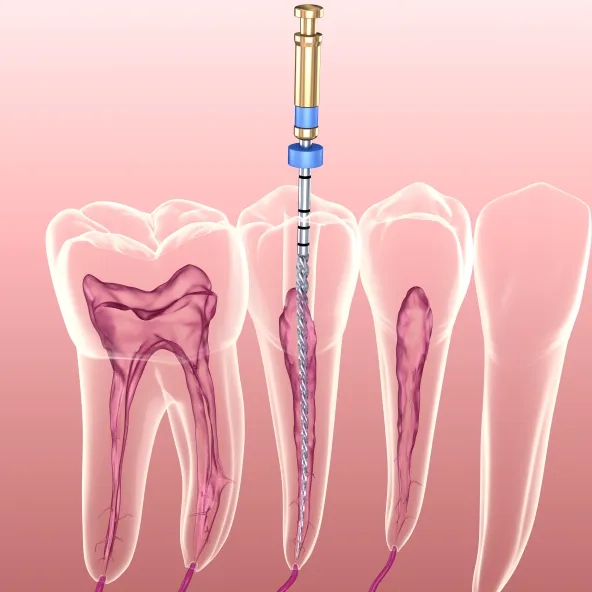 Imagem de uma simulação de como é feito um tratamento de canal no dente