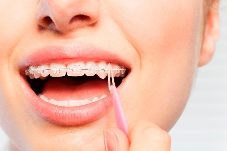Close de uma sorriso feminino com aparelho dental